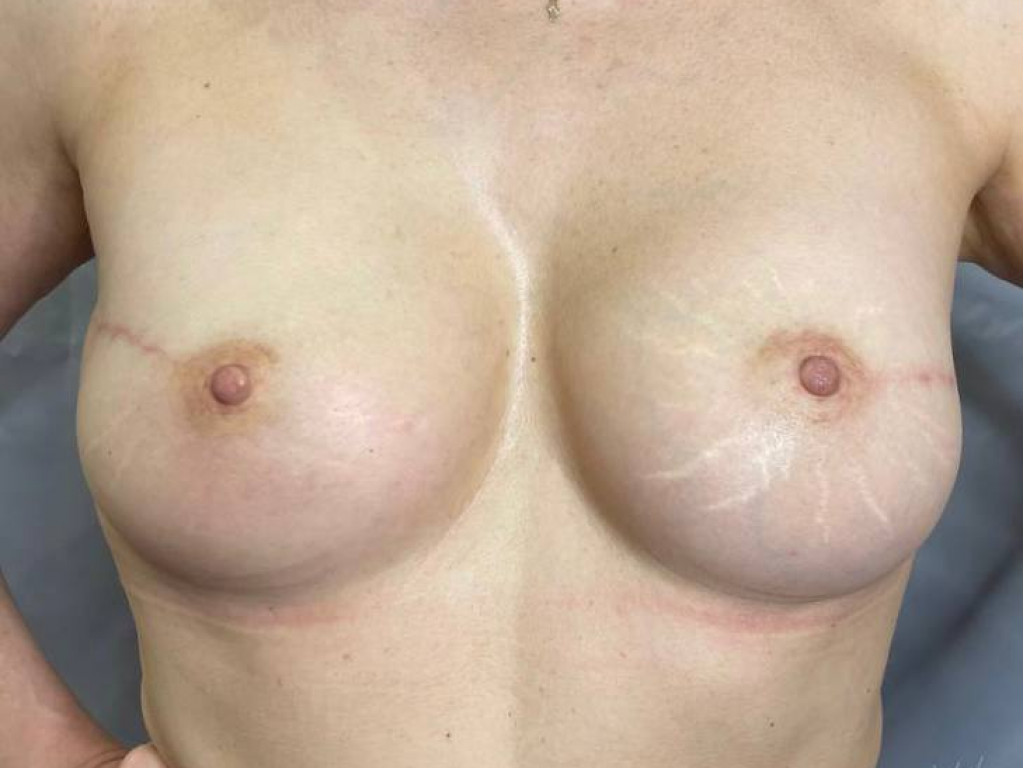 Реконструкция груди с одномоментной установкой имплантов