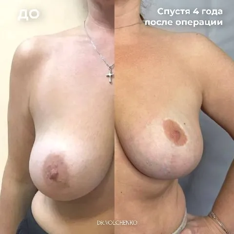 операционное уменьшение груди