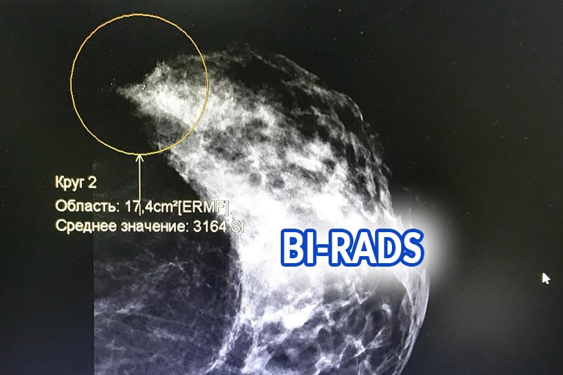 Маммография и BI-RADS
