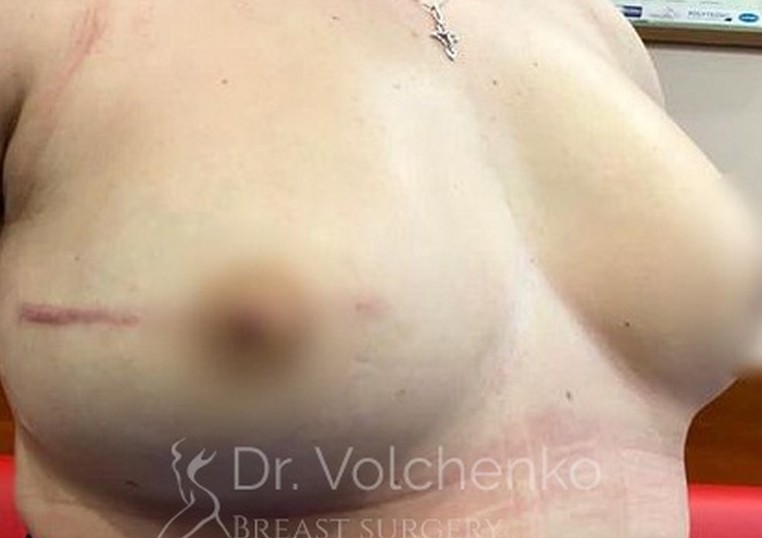 Реконстукция груди После операции