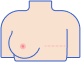 Операция по удалению груди (мастэктомия)